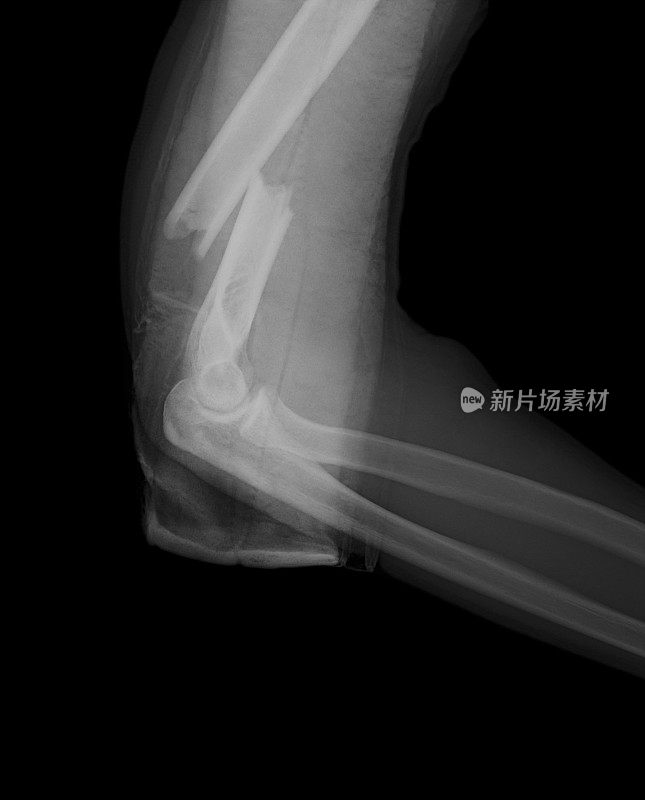 数字肘x线图像显示肱骨下段骨折