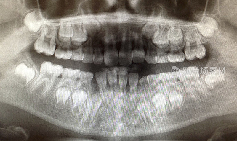 牙科x光图像