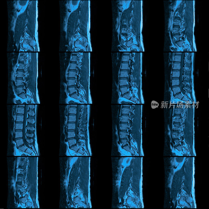 腰椎(下脊柱)MRI