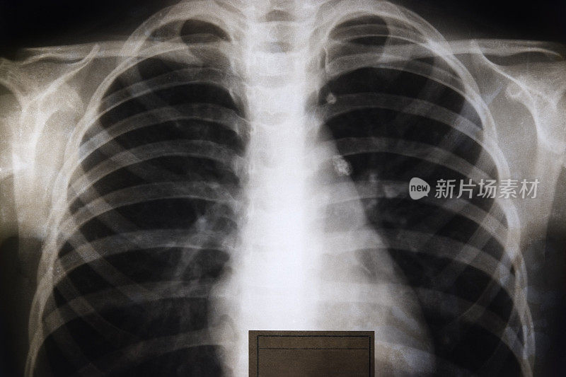 一位年轻女性胸部的旧x光片