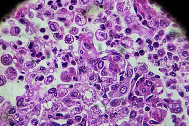 显微镜下小叶性肺炎人体病理生物样本