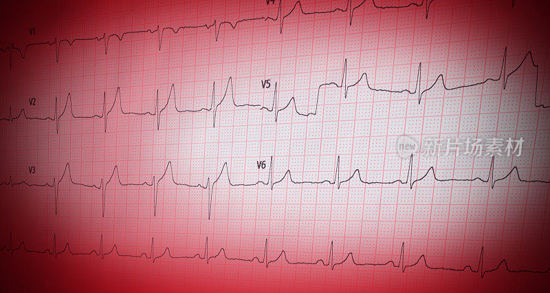 纸形式的心电图特写