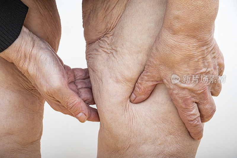 一位年长的女士抱着，拉着大量多余松弛的腿部皮肤，减肥后，做了胃绕道手术