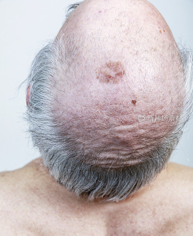 老年男子头顶的皮肤损伤