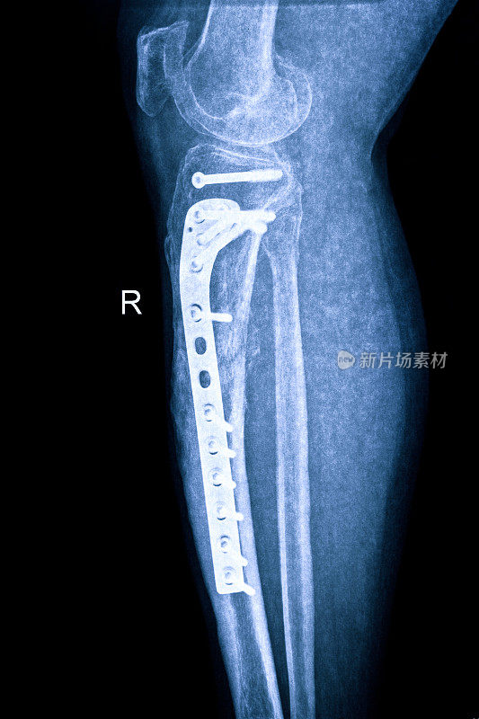 骨折腿的x线照片与骨合成材料