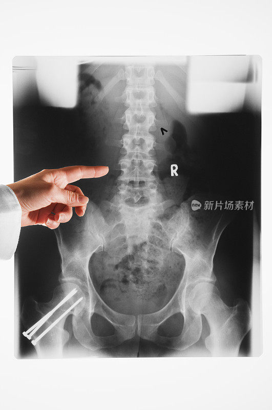 医生用手指骨盆和脊柱的x光片