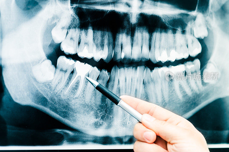 牙科医生在牙科x光图像上显示了一些东西