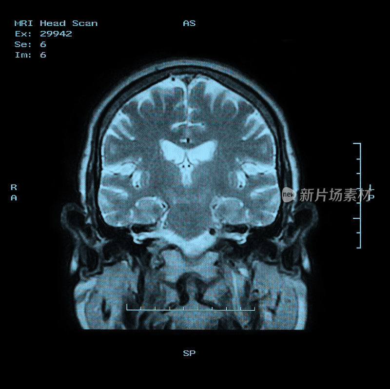 MRI头部扫描后视图