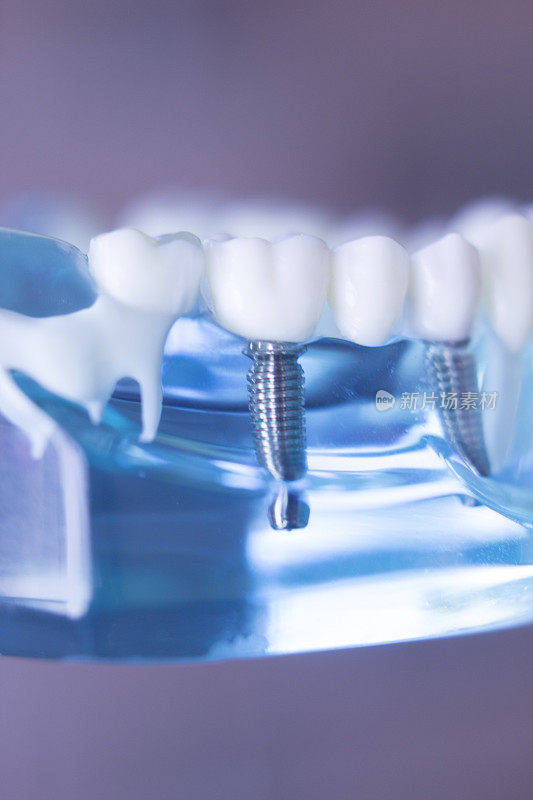牙科医生用钛金属螺钉种植牙模，教学生假牙、牙龈、牙根。