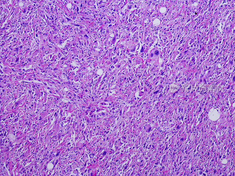 去分化脂肪肉瘤的显微照片