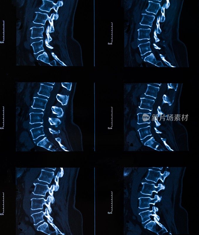 脊柱x射线胶片