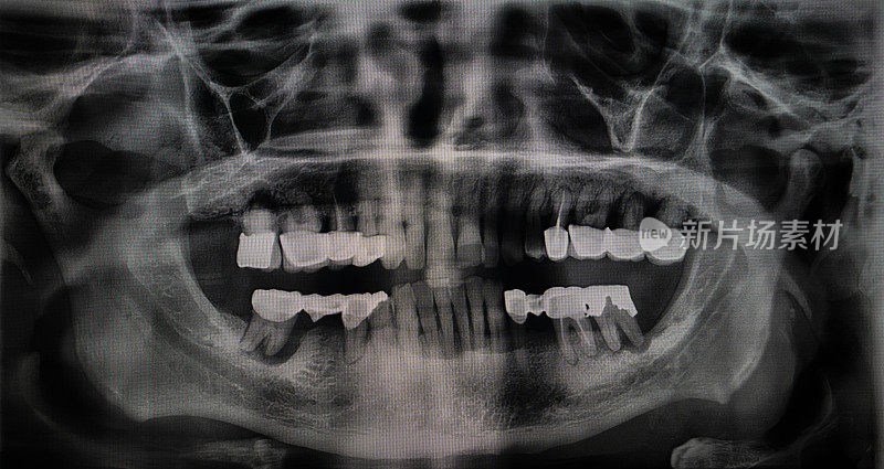 一位老人的牙科x光片。