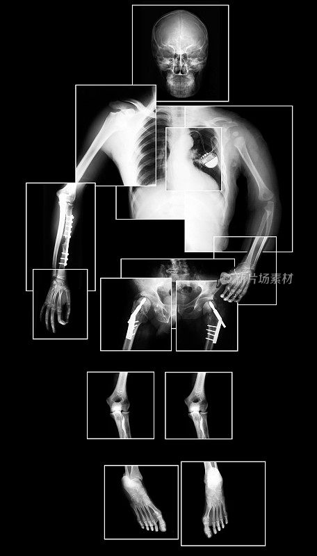 人体x光片