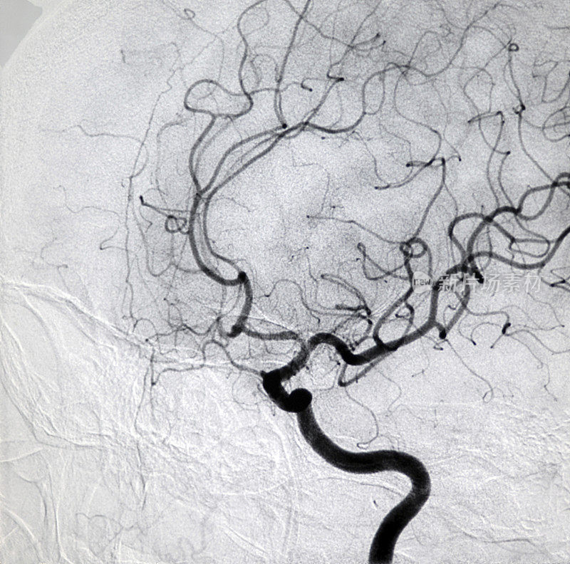 颈内动脉DSA图像