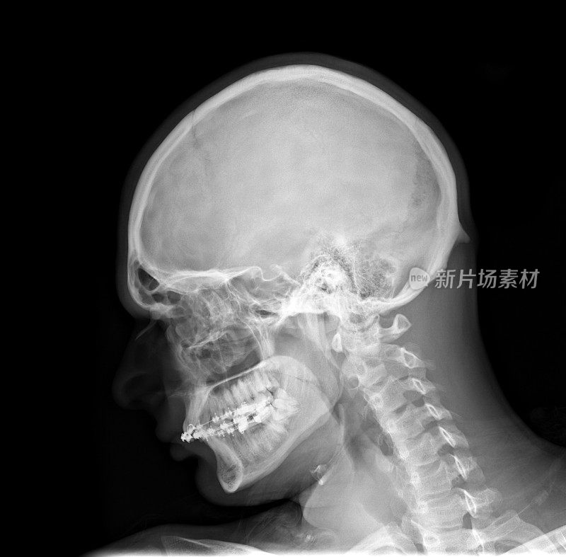 x光片-颅骨和颈椎