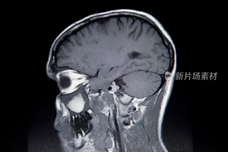 核磁共振大脑扫描