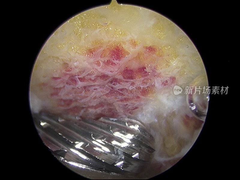 关节镜下使用毛刺的肩峰成形术