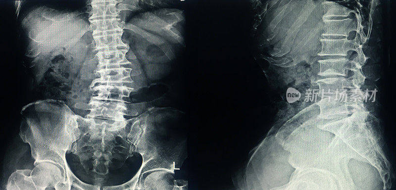 x线L-S脊柱侧凸和脊柱前凸曲线丧失。L3-4-5椎间盘间隙狭窄，伴有骨刺退变。正常的对齐。没有骨折,骨破坏。没有不透明的结石。正常的肠道气体模式。