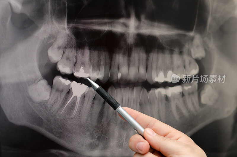 牙科医生在牙科x光图像上显示了一些东西