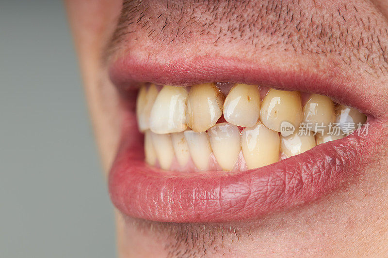 男性患者口腔有牙齿疾病。卫生和牙齿矫正问题