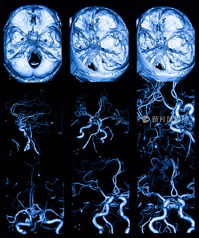 MRI扫描人脑和大脑动脉断层扫描