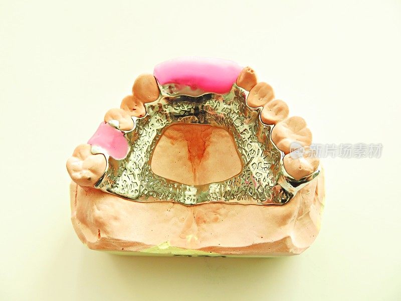 局部义齿的金属框架