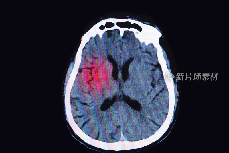 大脑的磁共振成像(MRI)