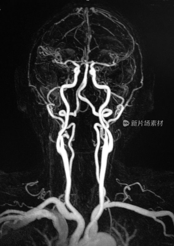 颈动脉血管摄影