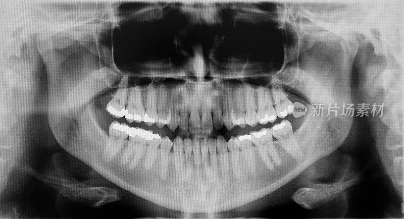 数字牙科x光片的全口牙和补牙