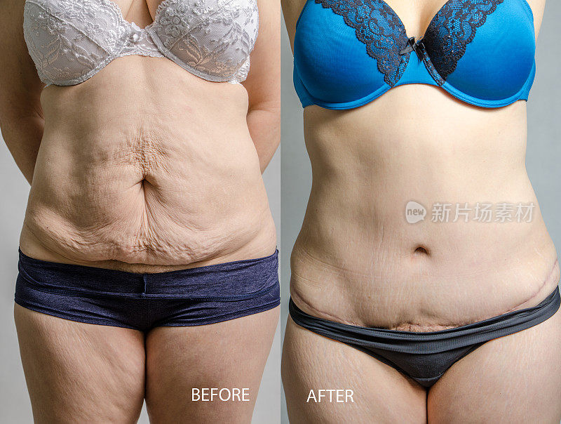腹部整形手术和抽脂手术前后的女性