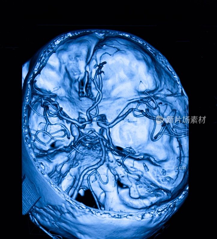 MRI扫描人脑和大脑动脉断层扫描