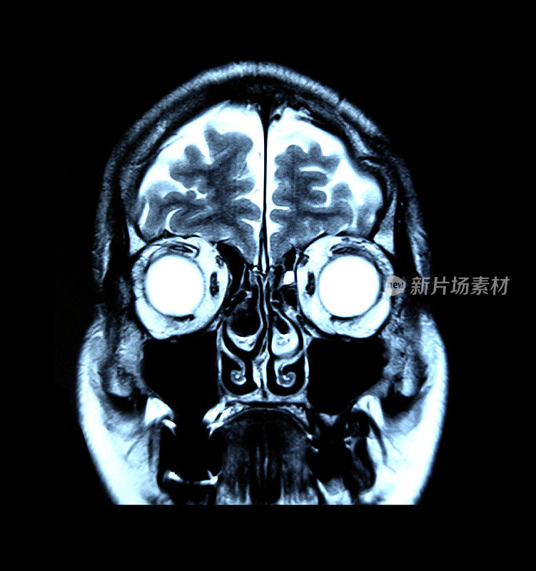 用颅骨对大脑进行磁共振扫描。