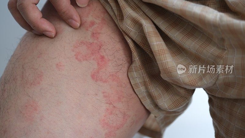 男人大腿上的过敏荨麻疹或卡里格塔。