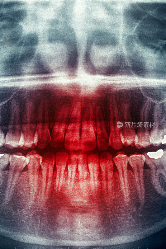 牙科x光片，恐怖头骨