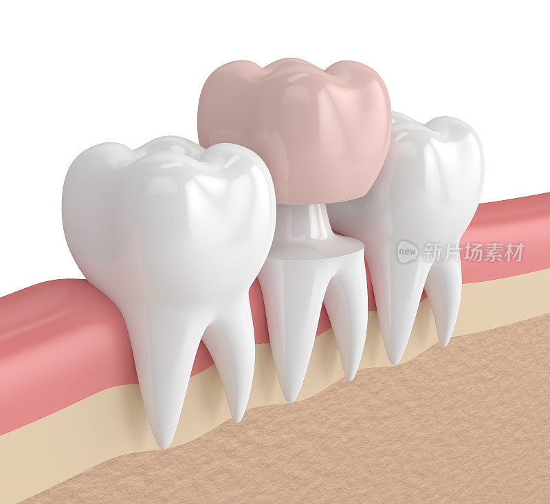 牙齿与牙冠修复的3d渲染