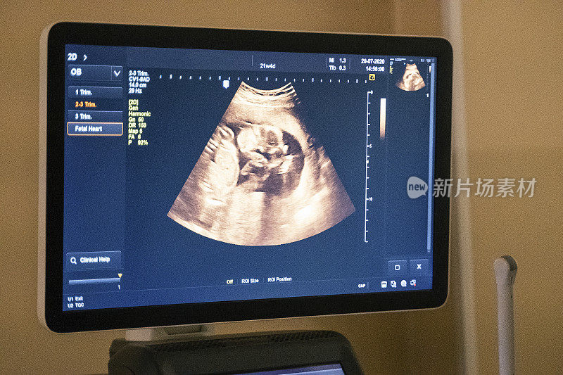 子宫内胎儿的超声波扫描。在怀孕期间为胎儿做超声检查。2019冠状病毒病期间的体检。