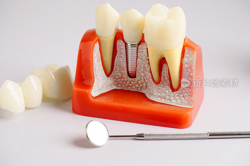 种植牙，下颌人工牙根，牙根管治疗，牙龈疾病，牙科研究用牙模型。