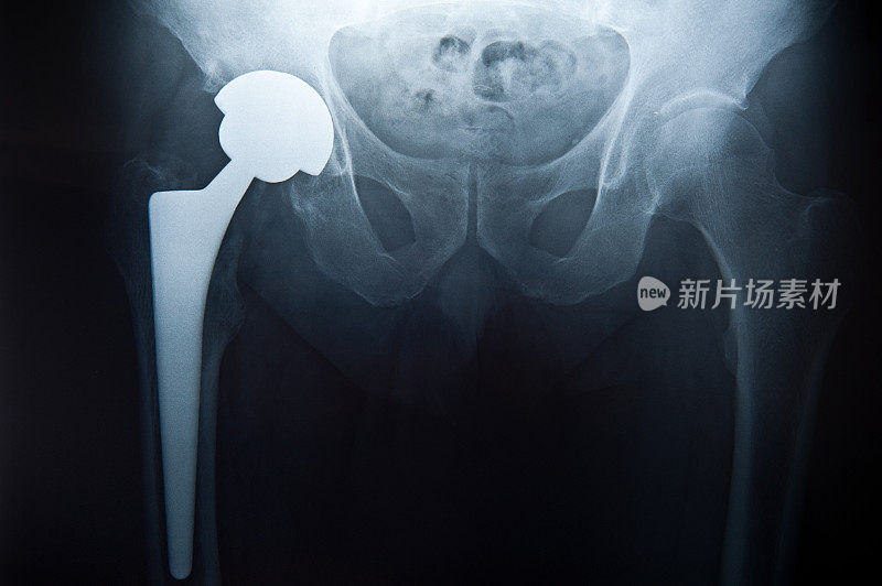 骨盆x光检查伴髋关节置换