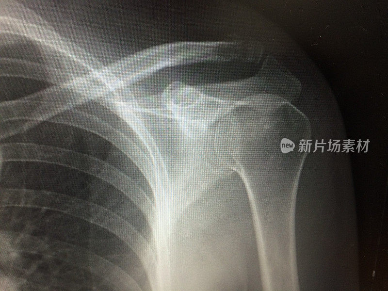 x线显示锁骨远端骨折