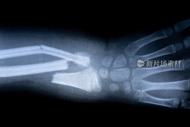 x光片骨骼人体手臂。健康医学解剖身体概念