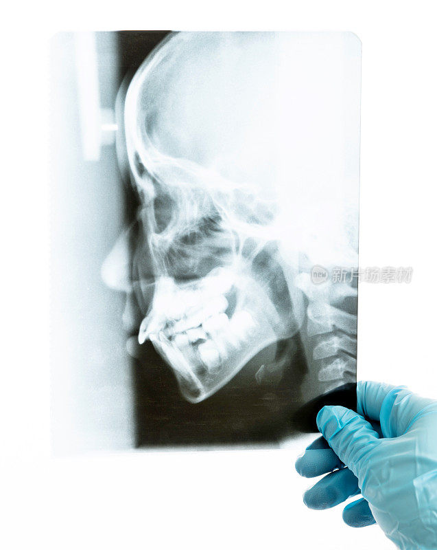牙医拿着一张白色背景的x光片