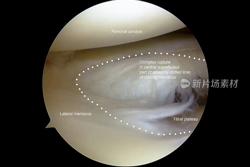 盘状外侧半月板复杂破裂的关节镜观察