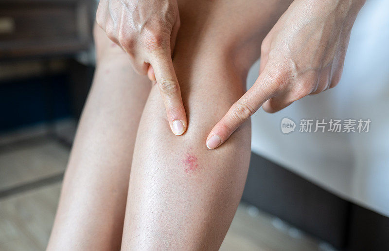 一个女人指着她大腿上的红色皮疹(或瘀伤)的特写。