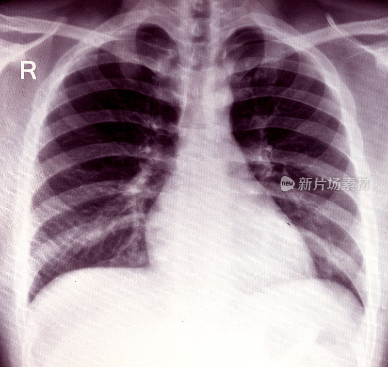 胸部x光图像