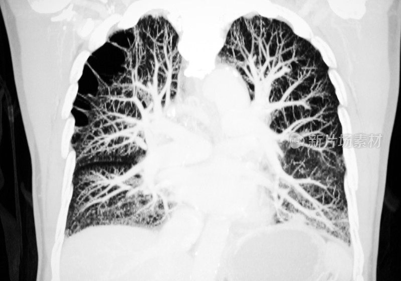 肺动脉CT图像