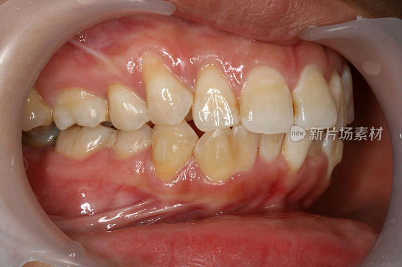 18个月后矫正牙齿(右侧图)