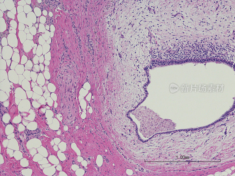 腹壁子宫内膜异位症。剖腹产疤痕