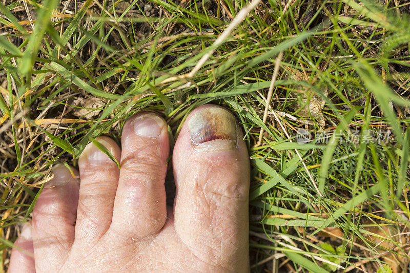 赤脚在草地上，大脚趾趾甲受损