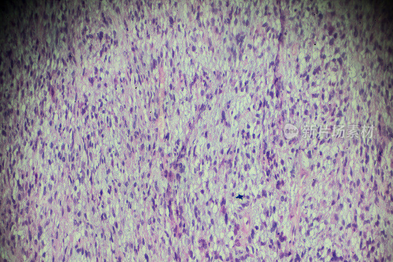 显微镜下横纹肌肉瘤活检