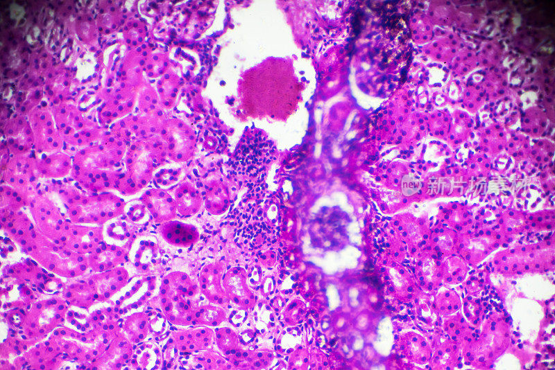 显微镜下急性肾盂肾炎活检标本